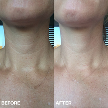 Load image into Gallery viewer, Neck Wrinkle Patch — Medical Grade Silicone Anti-Wrinkle Treatment