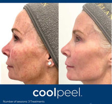 Load image into Gallery viewer, Ultimate Skin Rejuvenation Package — CoolPeel + Morpheus8 Face &amp; Neck