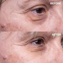 Load image into Gallery viewer, Eye Wrinkle Patches — Medical Grade Silicone Crow's Feet Treatment