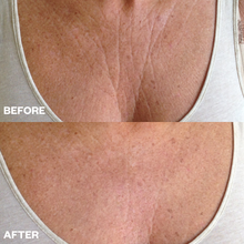 Load image into Gallery viewer, Chest Wrinkle Patch