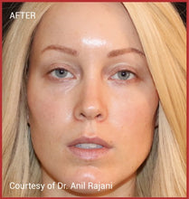Load image into Gallery viewer, EZ Gel all-natural PRP facial filler after photo showing natural volume results