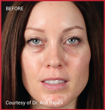 Load image into Gallery viewer, EZ Gel all-natural PRP facial filler before photo at Slender Me Medical